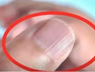 茄子视频破解版廠家分析手指甲有豎紋的根本原因 茄子视频破解版廠家分析手指甲有豎紋的根本原因